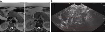 Case report: Induction and maintenance of steroid-free remission with vedolizumab in a case of steroid-dependent autoimmune pancreatitis